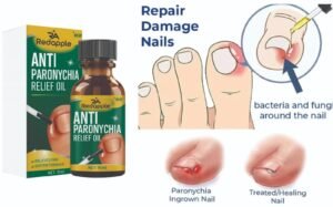 Anti Paronychia Relief Oil 20 ml Pack of 2 - Image 3